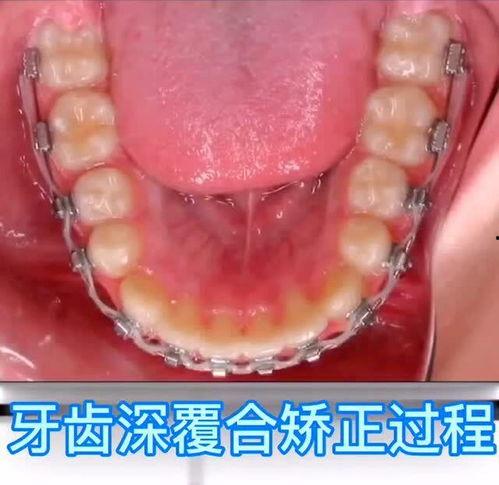 牙齿矫正视频全过程