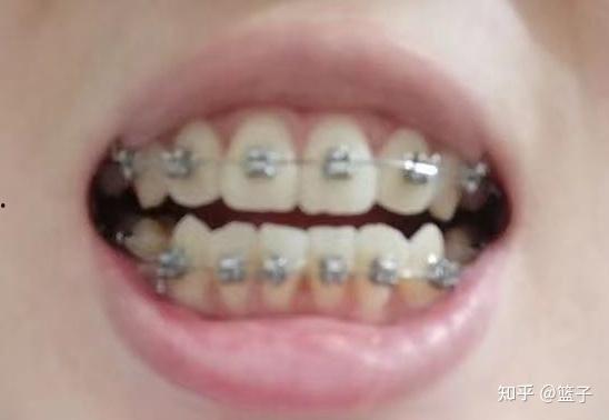 牙齿矫正视频全过程