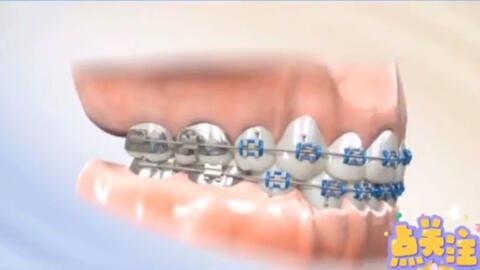 牙齿矫正视频全过程