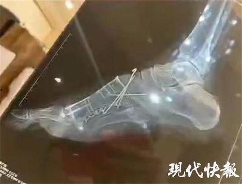 脚骨折视频,跟随视频见证脚骨折恢复全过程