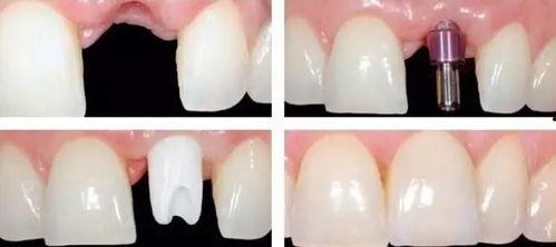 种牙过程视频,从术前准备到术后恢复