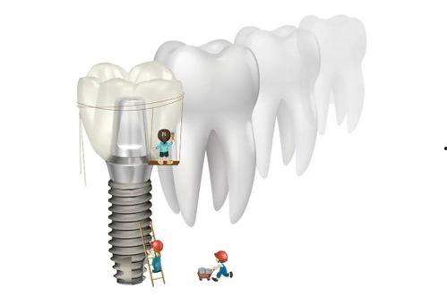 种牙过程视频,从术前准备到术后恢复