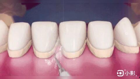 洗牙视频,跟随视频学习口腔清洁新技能