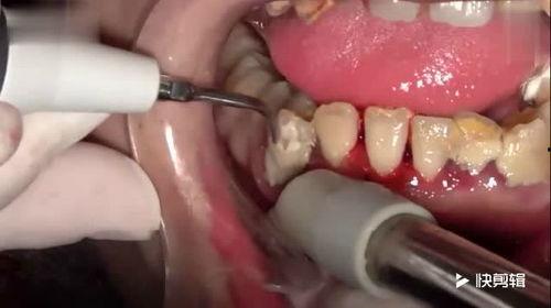 牙结石视频,视频揭秘口腔健康之道