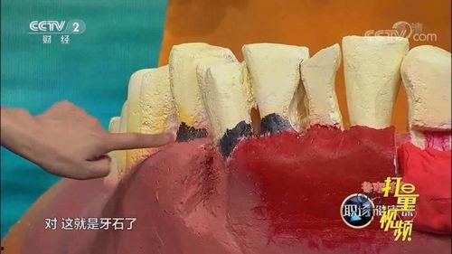 牙结石视频,视频揭秘口腔健康之道