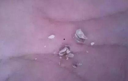 牙结石视频,视频揭秘口腔健康之道