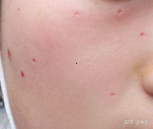 取痣视频,安全无忧——跟随视频学习专业取痣技巧