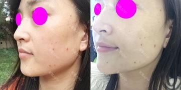 取痣视频,安全无忧——跟随视频学习专业取痣技巧