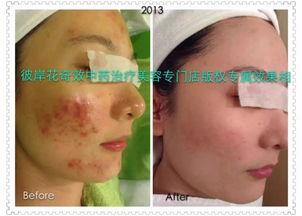 取痣视频,安全无忧——跟随视频学习专业取痣技巧