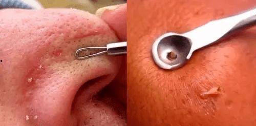 挤鼻子上的黑头视频,告别毛孔粗大困扰