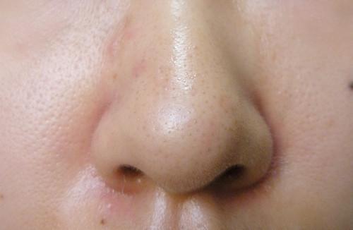 挤鼻子上的黑头视频,告别毛孔粗大困扰