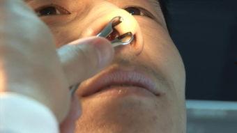 鼻窦炎视频,症状、成因及防治方法一览